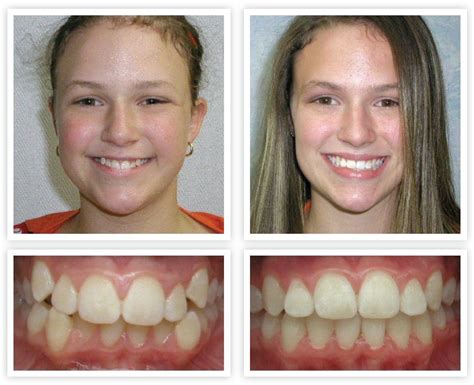 Orthodontic Treatment | Roanoke, VA Dentist