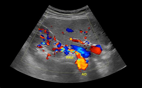 Renal Arterial Doppler Study in Cumming and Suwanee, GA | North Atlanta ...