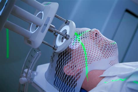 Stereotactic Radiosurgery in SCLC With Brain Metastasis - Cancer ...