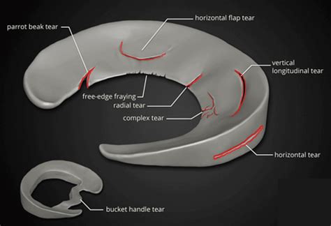 The Complete Guide to a Meniscus Tear | Kinetic Labs