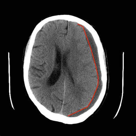 Subdural haematoma | Subdural Haemorrhage | Geeky Medics