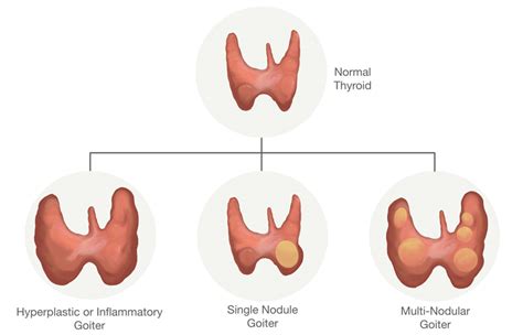 Goiter - Larian, MD