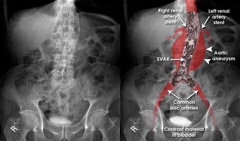 X Ray Images Of Aortic Tear