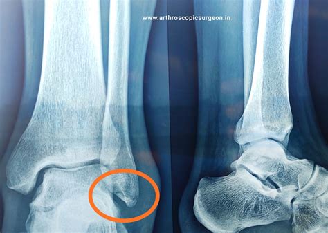 Ankle sprain – Best Orthopedic doctor in Jaipur