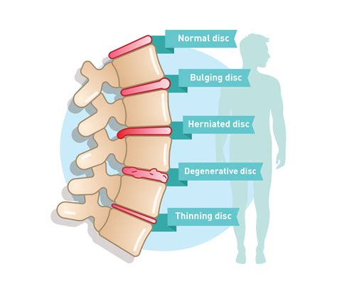 Degenerative Disc Disease Treatment, Symptoms & Causes | QI Spine