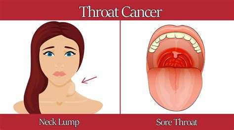 Can A Sore Throat Be A Sign Of Cancer - CancerWalls