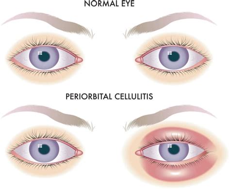 Periorbital Cellulitis | MyVision.org