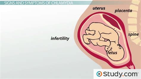 What Is Chlamydia Trachomatis? - Symptoms, Signs & Treatment - Lesson ...