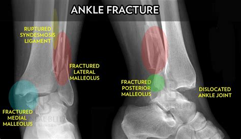 Tibia And Fibula Ankle Fracture