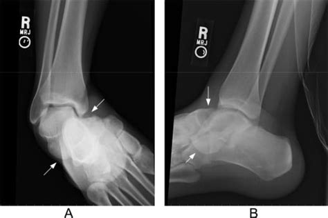 Subtalar Dislocation - The Western Journal of Emergency Medicine