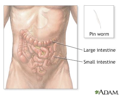 Pinworm test Information | Mount Sinai - New York