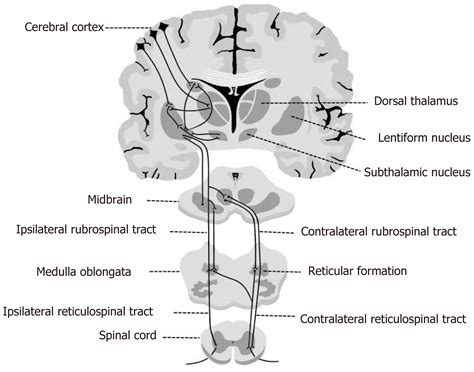 Hemichorea due to ipsilateral thalamic infarction: A case report