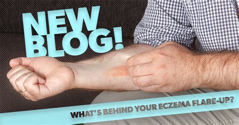 What’s behind your eczema flare-up? - ActivMed Practices & Research, LLC