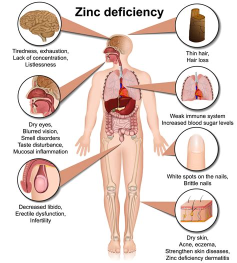 FIRST SIGNS OF LOW ZINC (A ZINC DEFICIENCY) - Nutrition 4 IBD