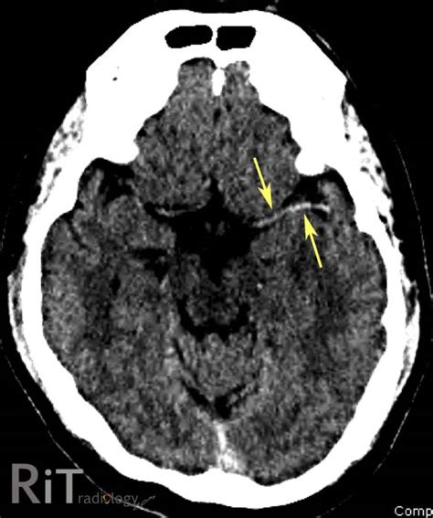 RiT radiology: Hyperdense Middle Cerebral Artery Sign