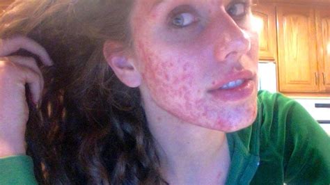 Cute girls with acne. 12 Beautiful Pictures of Acne Scars15 Things ...