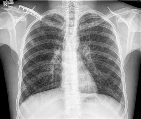 Chest X-Ray Projection | Chest X-Ray - MedSchool