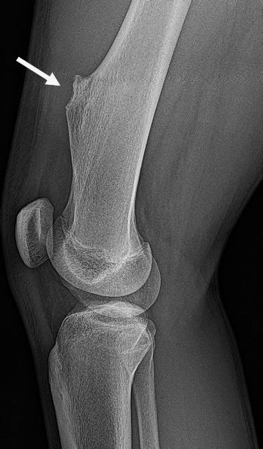 Osteochondroma: Causes, Symptoms and Treatments | HSS