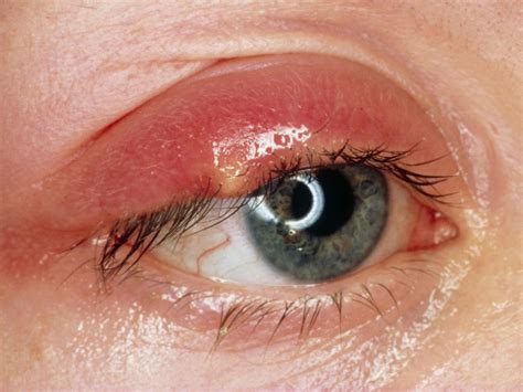 Stye - Symptoms and Treatment