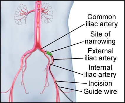 Iliac Artery Stent