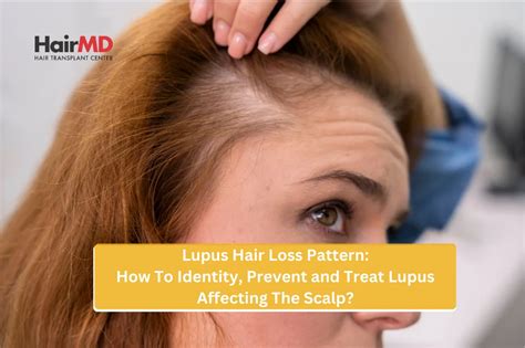 Identify Lupus Affecting Hair Scalp : Prevent and Treatment