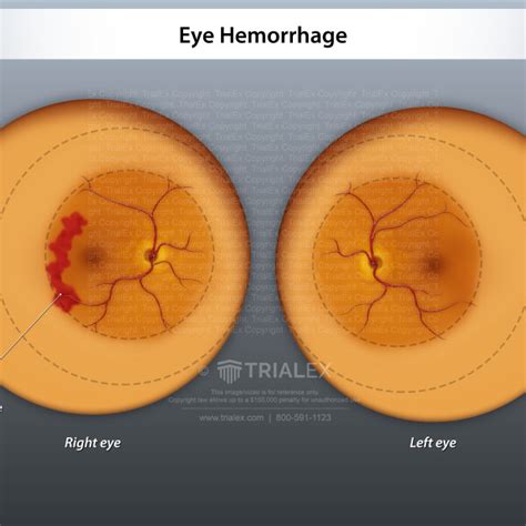 Eye Hemorrhage - TrialExhibits Inc.