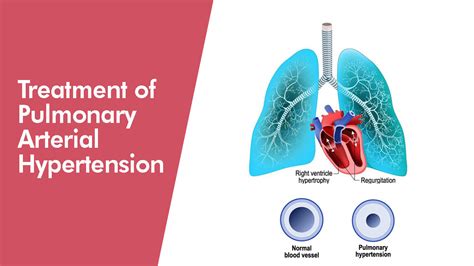 TREATMENT OF PULMONARY ARTERIAL HYPERTENSION - German Heart Centre