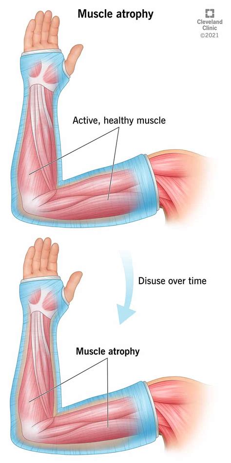 Muscle Atrophy: Causes, Symptoms & Treatment