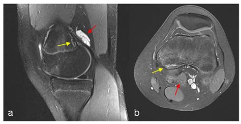 Fibrous Cortical Defect Mri