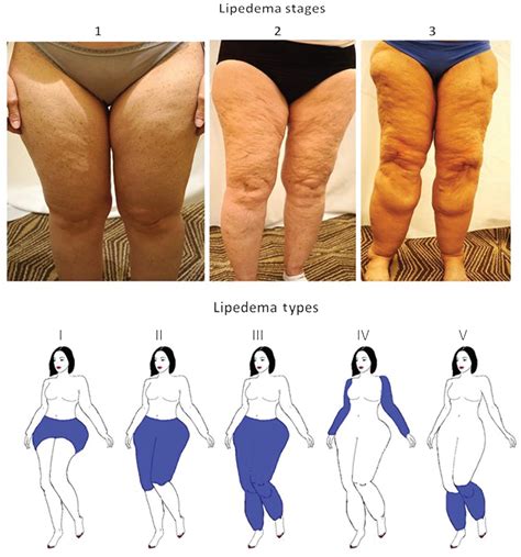 Learn About Stages And Types Of Lipedema