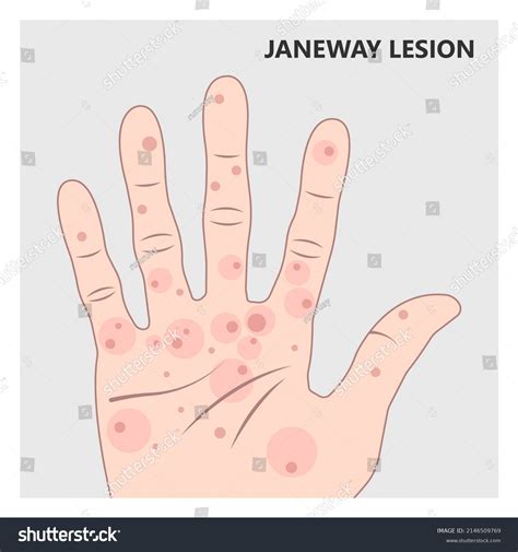 18 Janeway Lesions Images, Stock Photos & Vectors | Shutterstock