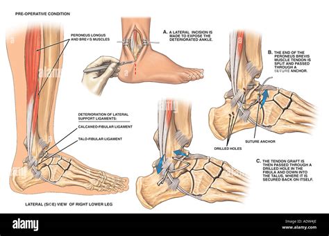 Sprained Ankle Surgery Anatomy Diagnosis Operation