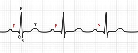 The P Wave | ECG Basics - MedSchool