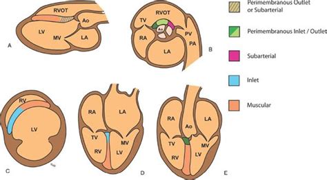 Ventricular Septal Defects | Thoracic Key