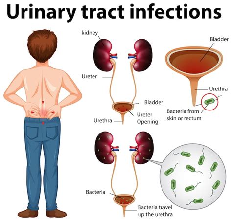 Urinary Tract Infections Utis Symptoms Free Vector | Venzero