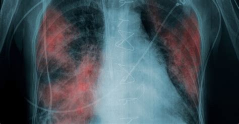 Lung Damage From Vaping: Why Is This Happening?