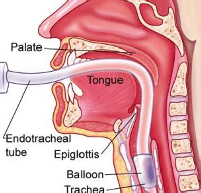 Endotracheal tube placement [ 3 ] | Download Scientific Diagram