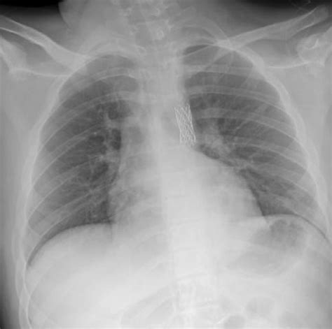 -Portable chest x-ray . The presence of a projected aortic stent is ...