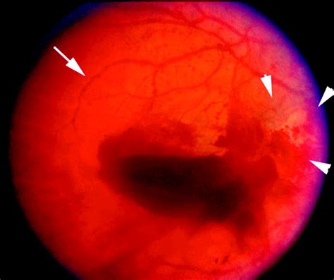 Retinopathy: Valsalva Retinopathy Treatment