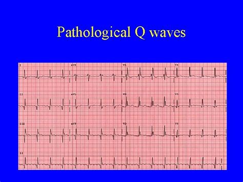 Pathological Q Wave