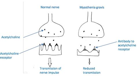 Acetylcholine Receptor Myasthenia Gravis