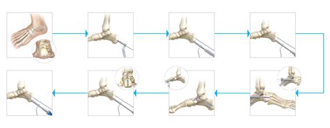 Triple Arthrodesis | Acutrak Advantage