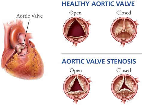 Aortic Valve Stenosis - Causes, Symptoms, Life Expectancy, Treatment