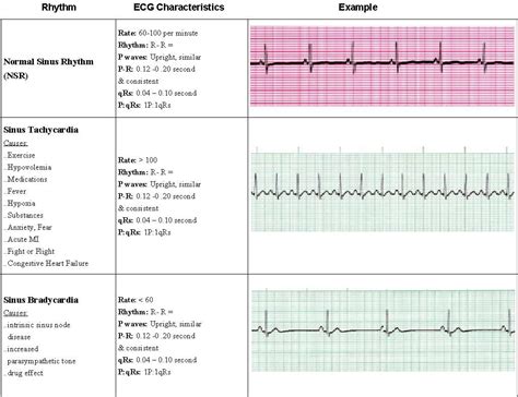 ACLS EKG Rhythms