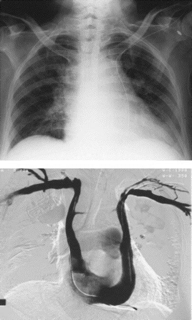 Persistent left superior vena cava - The Lancet