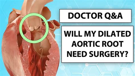 Doctor Q&A: The Progression and Surgery of Dilated Aortic Root ...