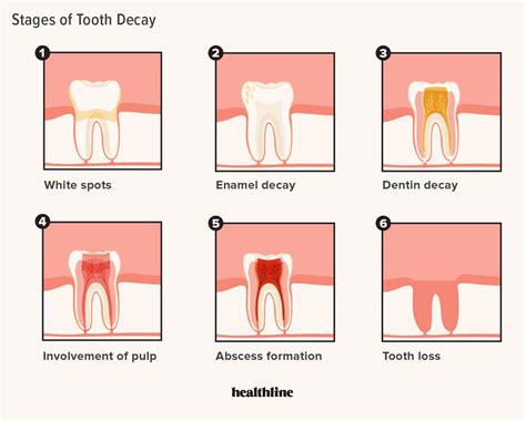 Tooth Decay Stages: 5 Stages and How to Treat Each