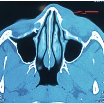 Preoperative photograph showing medial canthus swelling | Download ...