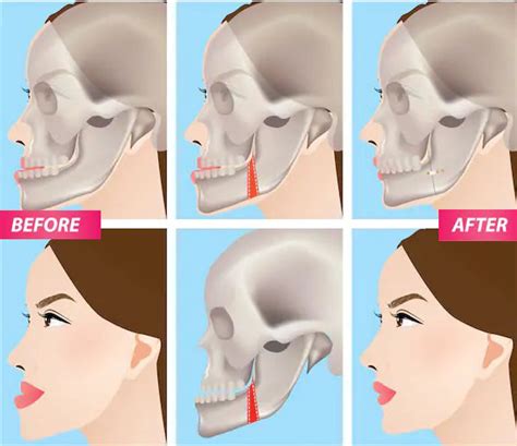 Alignment of the jaw with Orthognathic surgery | Dr Sanjay Ranchod