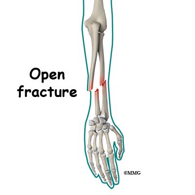 Fractures, Open; Fractures, Compound